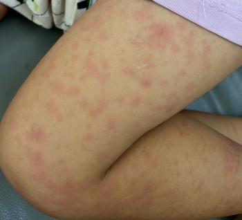 Bộ Y tế tăng cường kiểm tra công tác phòng, chống dịch sởi tại thành phố Đà Nẵng