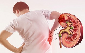Dấu hiệu của bệnh sỏi thận