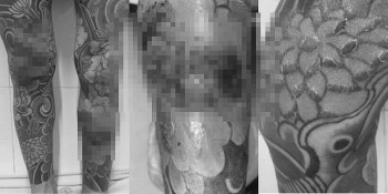 Nam thanh niên nhập viện vì dị ứng gây ngứa ngáy sau khi xăm