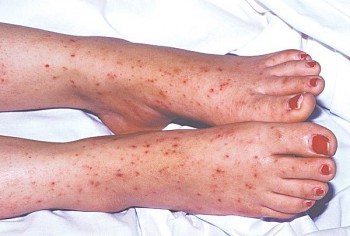 Phát hiện ca viêm màng não mô cầu đầu tiên tại Đồng Nai