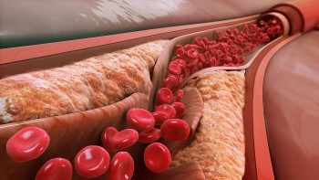Gần một nửa người trưởng thành Việt Nam có cholesterol cao