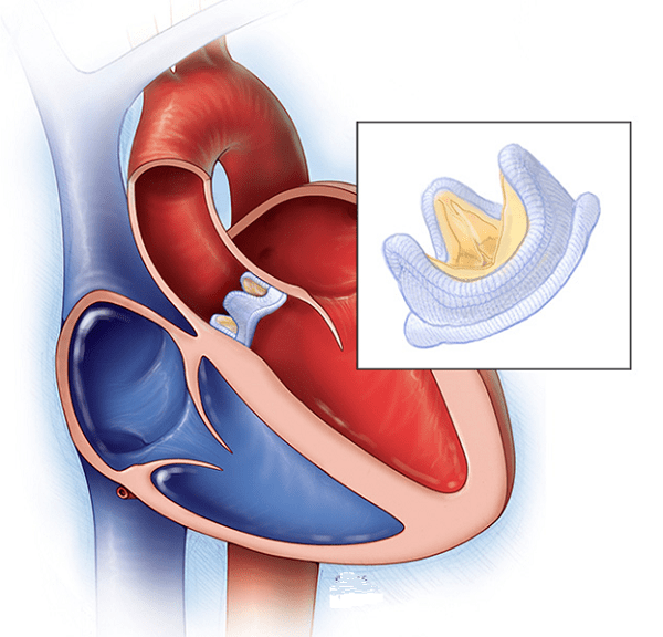 Hẹp van động mạch chủ là một trong những bệnh lý van tim phổ biến và nguy hiểm nhất ở người cao tuổi Hẹp van động mạch chủ là một trong những bệnh lý van tim phổ biến và nguy hiểm nhất ở người cao tuổi