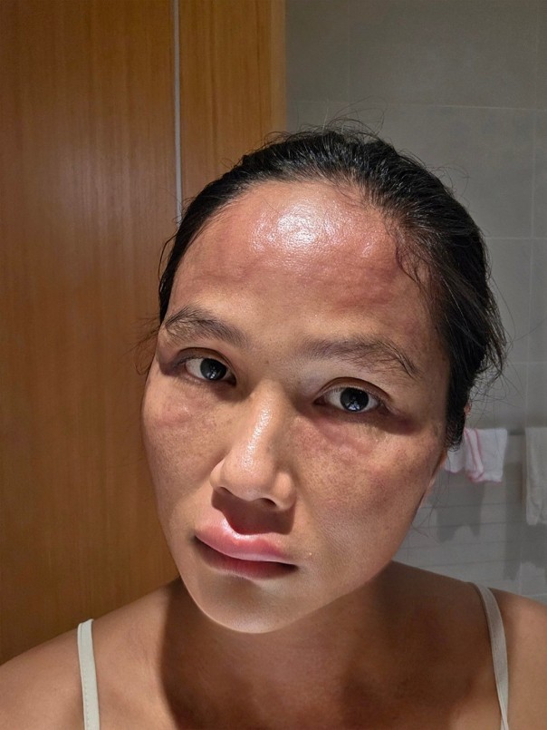 Hoa hậu H'Hen Niê đã đăng tải hình ảnh gương mặt sưng tấy. Hoa hậu H'Hen Niê đã đăng tải hình ảnh gương mặt sưng tấy.