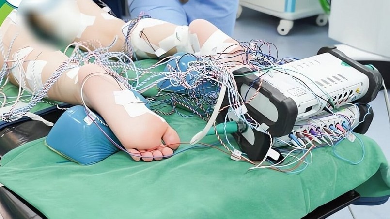 Bệnh nhi được đặt điện sinh lý để tìm dây thần kinh gây co cứng. Bệnh nhi được đặt điện sinh lý để tìm dây thần kinh gây co cứng.