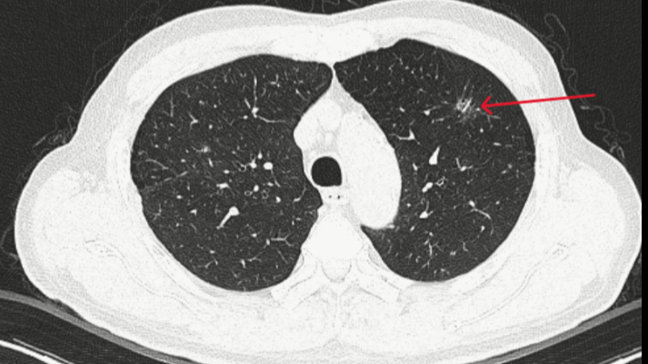 Bệnh nhân được phát hiện ung thư phổi giai đoạn rất sớm nhờ hệ thống phân tích hình ảnh bằng trí tuệ nhân tạo (AI) Bệnh nhân được phát hiện ung thư phổi giai đoạn rất sớm nhờ hệ thống phân tích hình ảnh bằng trí tuệ nhân tạo (AI)