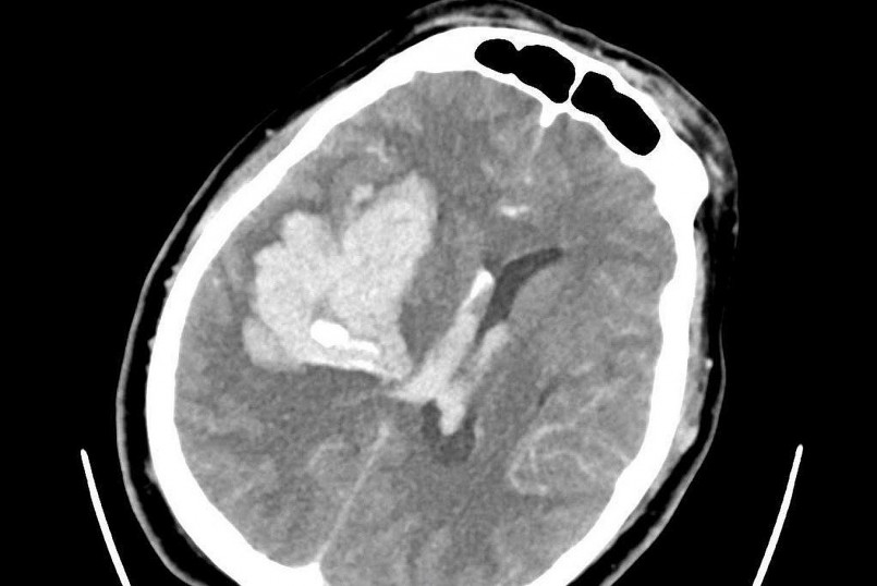 Ảnh chụp CT cho thấy bệnh nhân bị xuất huyết não nặng (Ảnh: BS).